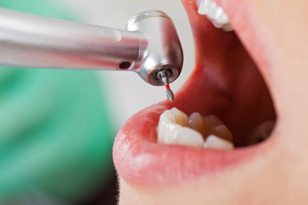 Best Broken or Chipped Tooth Repair in Apple Valley, UT
